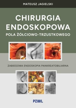Chirurgia endoskopowa pola żółciowo-trzustkowego. Zabiegowa endoskopia pankreatobiliarna